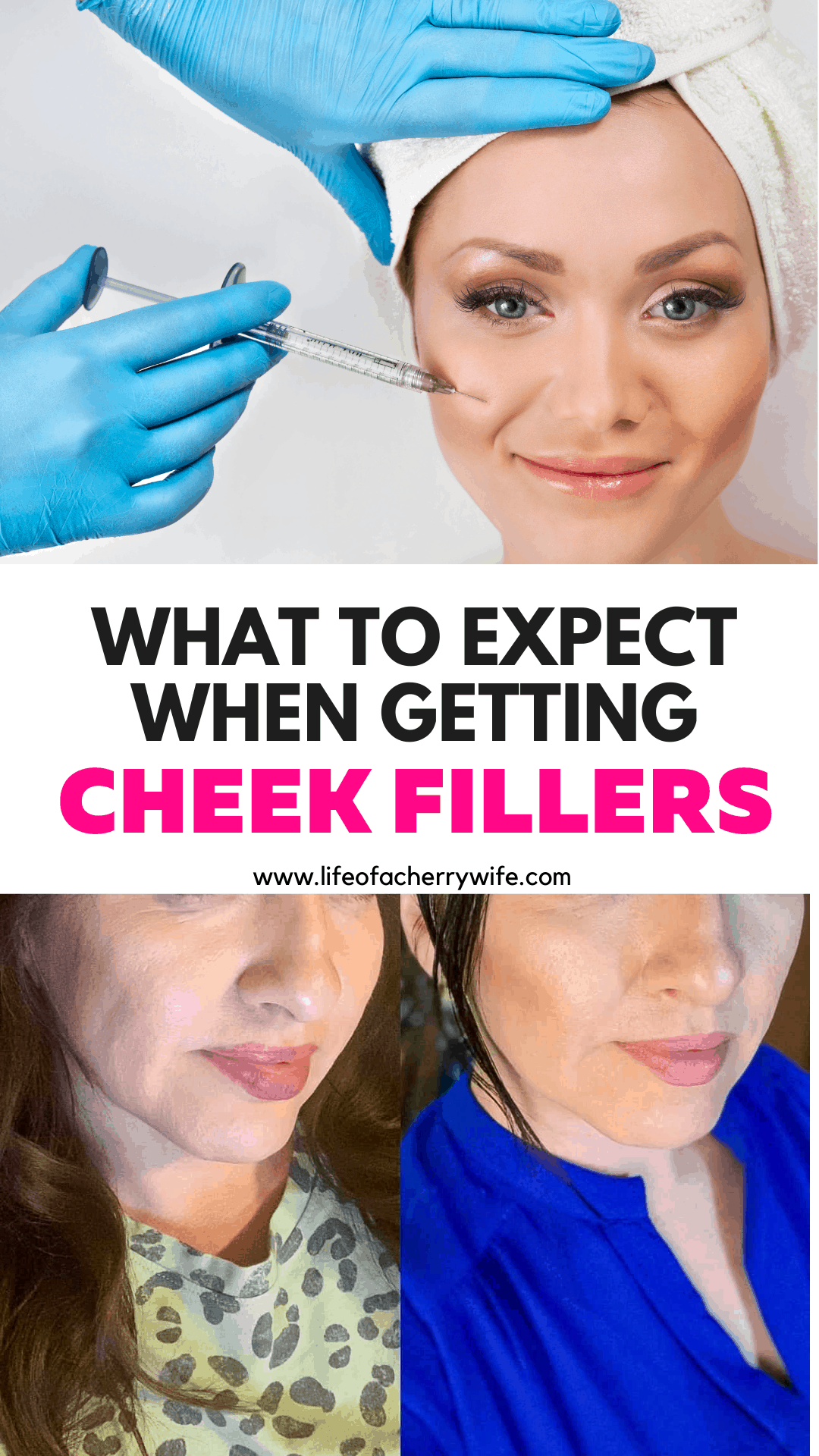 What To Expect When Getting Cheek Fillers #cheekfillers #injectables